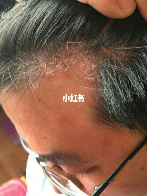 头藓 牛皮癣_头皮屑_银屑病_医疗健康_医疗健康其他