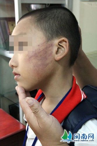 和小赖分成一组打耳光的小陈同学,左脸颊留有红红的巴掌印