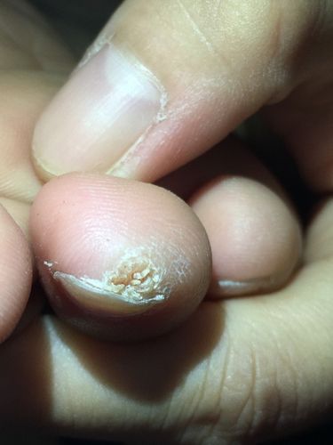 请问这是甲周疣嘛?