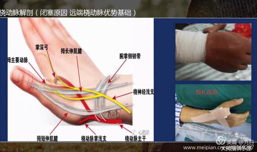 经远桡动脉行pci,疗却顽疾新境界——长治市人民医院胸痛中心新技术又