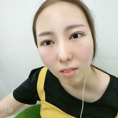 丹凤眼变清新双 项目分类:眼部整形 双眼皮 切开双眼皮