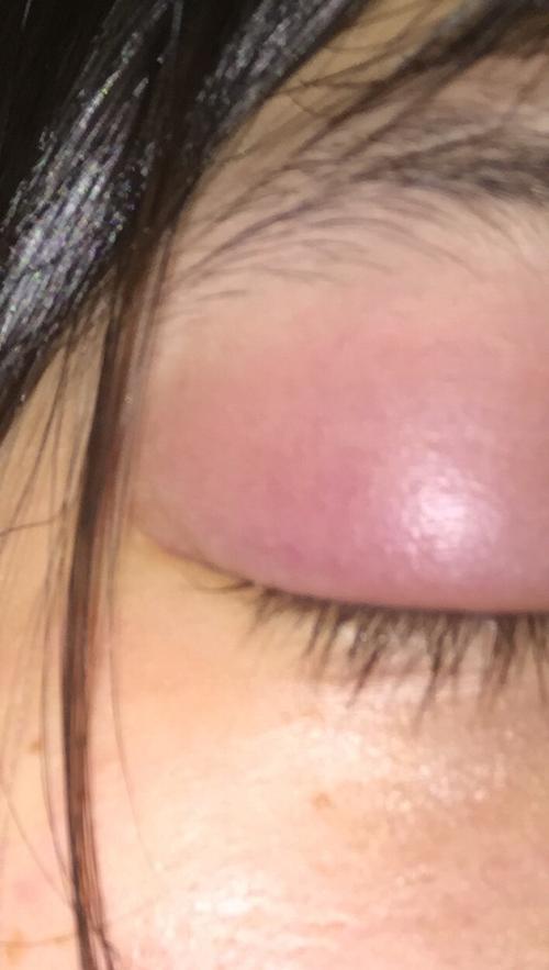 上眼皮肿了 持续了大概三天左右 就是睡一觉突然这样了 轻微疼痛感.