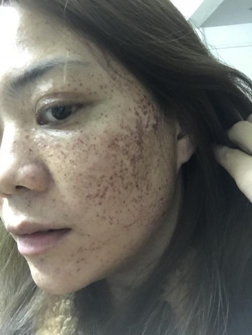 4.5雀斑 黄褐斑无创技术