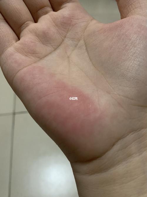 小鱼际发红是怎么回事啊_医疗健康_医疗健康其他