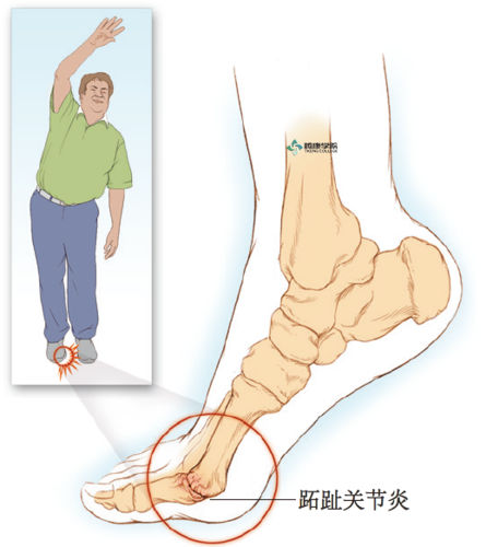 疼痛解剖学|组织关节炎性痛
