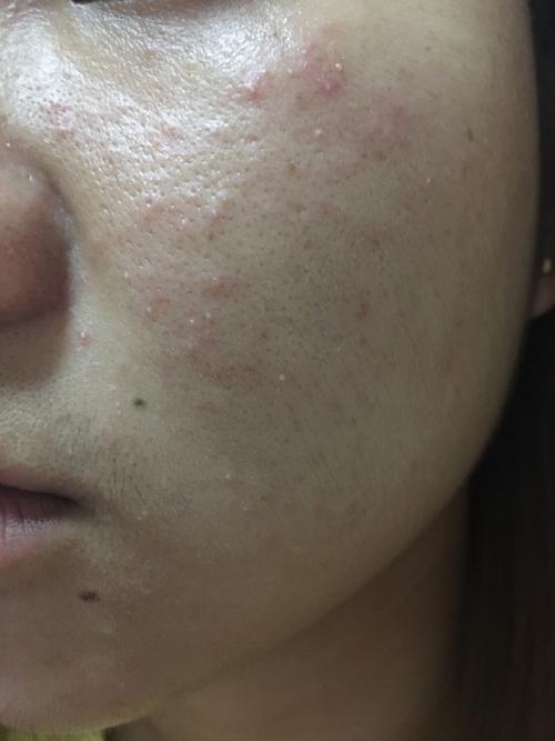 求助这是激素脸还是毛囊炎还是脂溢性皮炎