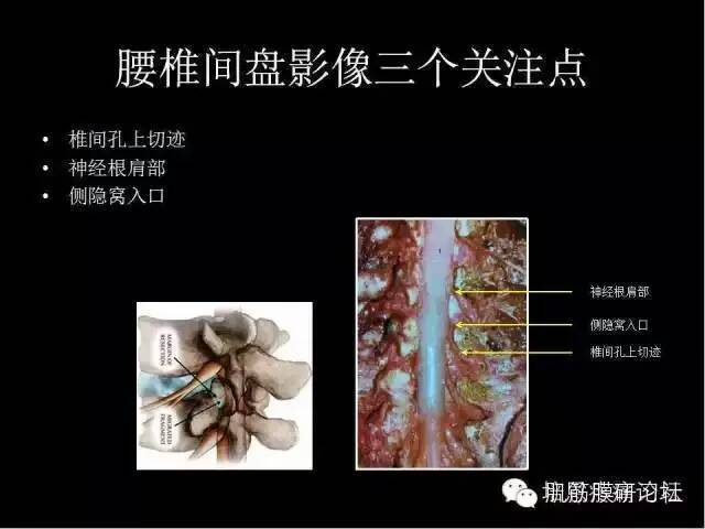 柳健301讲课笔记——腰椎间盘突出的影像解读