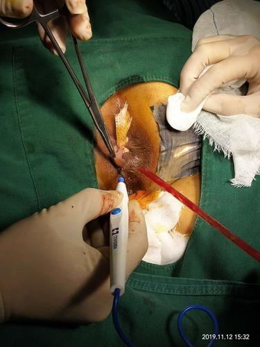 切除,结扎外痔部分