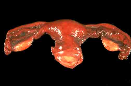 正常子宫输卵管卵巢图片3