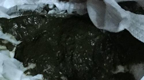 大便黑色是什么原因?