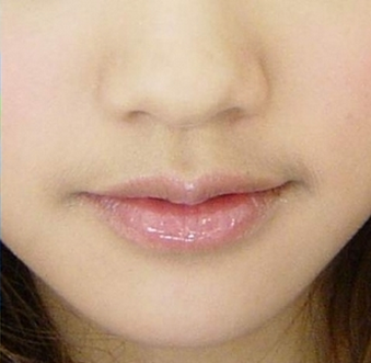 女生嘴上长唇毛,到底要怎麼办?