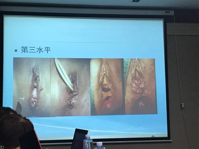 顺行式阴式手术(贾)