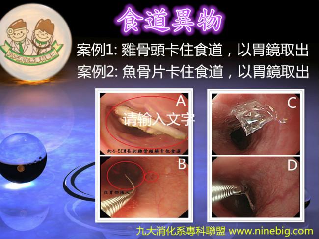 突然吞咽困难并胸闷---再谈食道异物