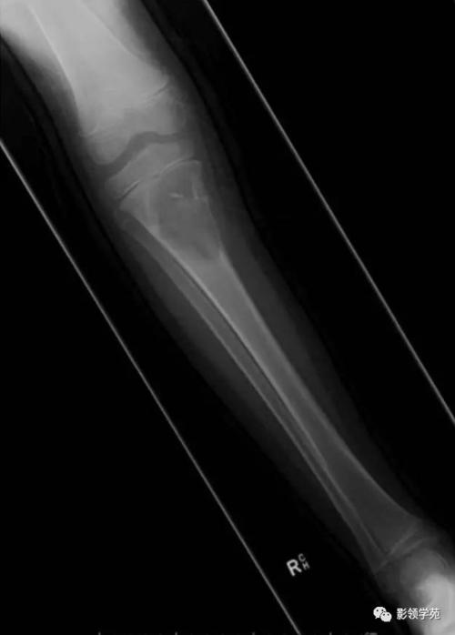 动脉瘤样骨囊肿影像学解析