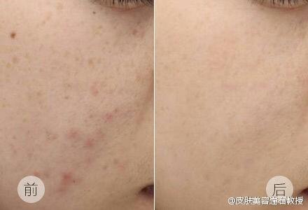 摆脱月球脸痘坑完美攻略