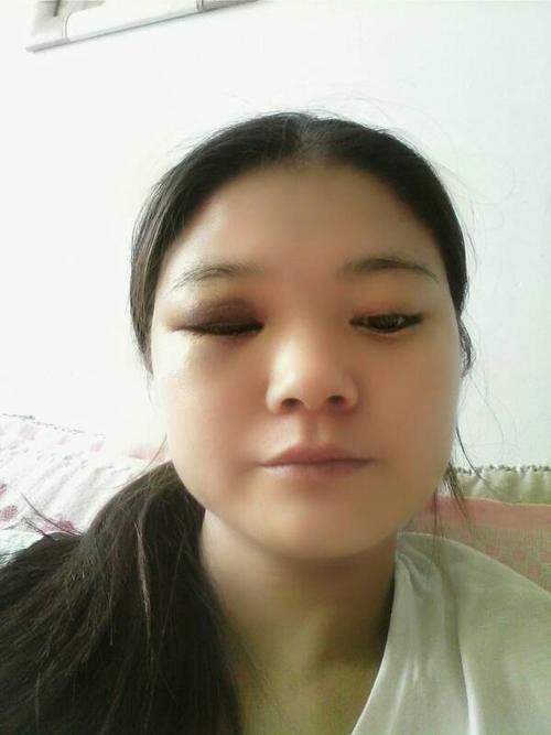 我眼睛撞桌角了, 肿了,还有紫色一大块两天了还有点肿, 有点紫,怎么办