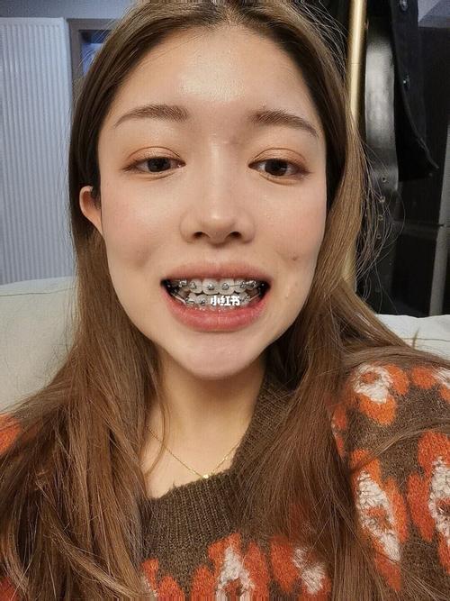 戴牙套475天_法令纹_牙套_清洁_冲牙器_少女感_牙齿矫正_美妆_医美