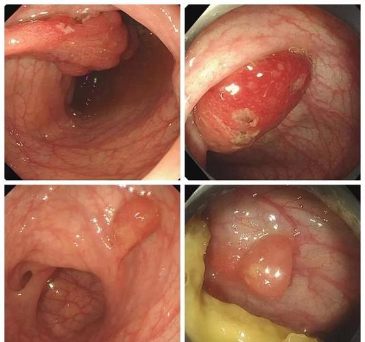 "息肉形状大小各不相同,有菜花状,有分叶状,有球状的,有带着长蒂,有