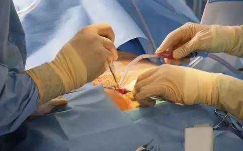 正经科普:男人结扎原来是这个样子的,看完下头一紧