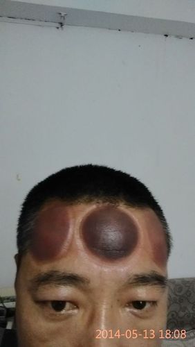 揪痧拔罐释疑(二十八)——关于拔脑门