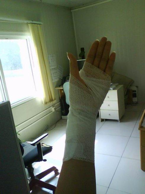 下场就是手被缠上白白的纱布,变成粽子.