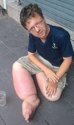 外媒报道了这样一则新闻,一个在亚洲臭名昭著的巨腿症乞丐被韩国驱逐