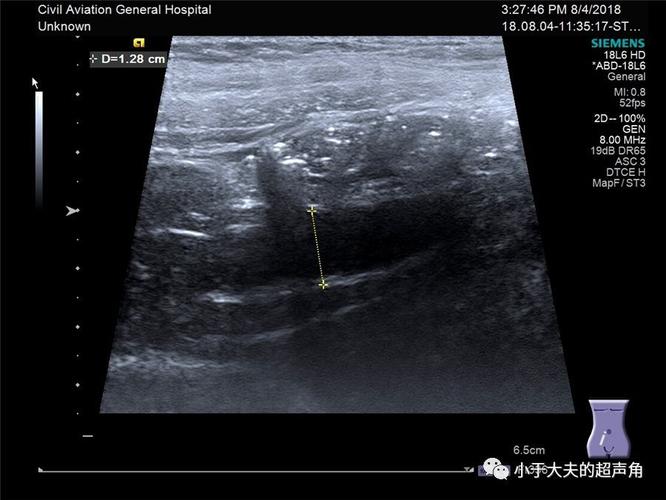 读书笔记小儿急性阑尾炎