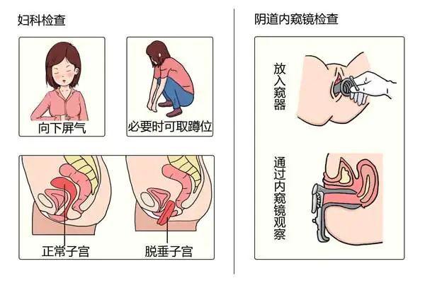 为什么产后会子宫脱垂?每位女性都应知悉!