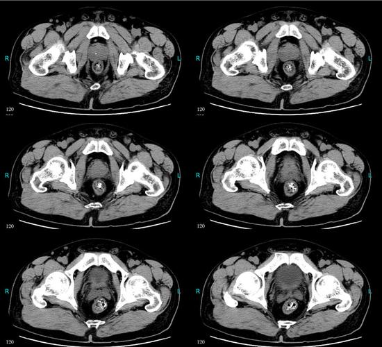膀胱癌(低级别非浸润性尿路上皮癌)