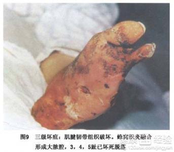 糖尿病足的症状及治疗