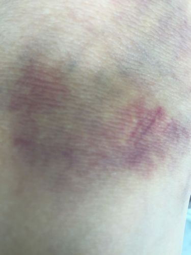 请大大们看看,我老婆这个手臂上怎么了,轻轻一捏就紫?