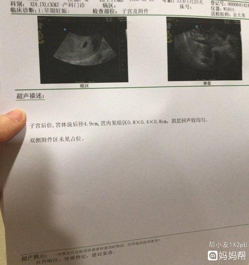 孕5周 1天,阴道彩超是这样,可以排除宫