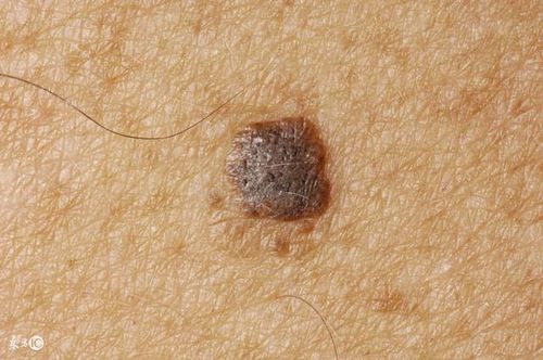 美容科医生汤爱荣:年轻人防止老年斑,这8招管用!