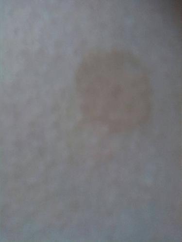 我的皮肤上长了几个褐色的圆斑,这是什么情况?