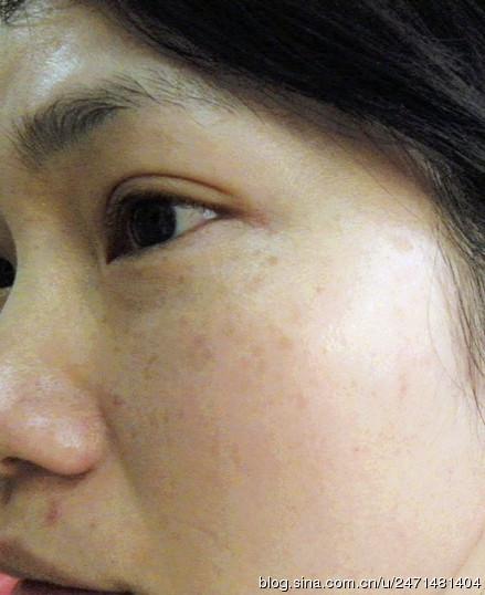 女性面部色斑的形成与内分泌有关