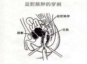 这种脓肿可局限于子宫的一侧或双侧,脓液流入于盆腔深部,甚至可达直肠
