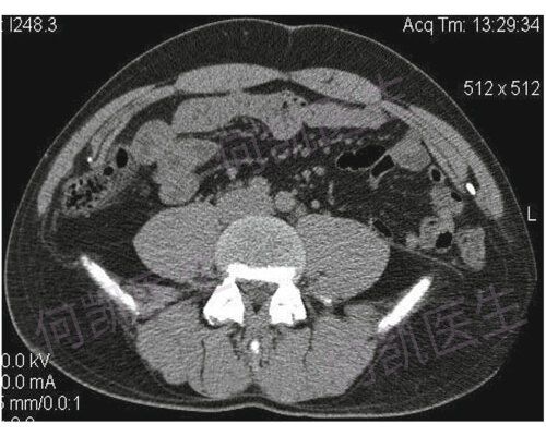 腰疝是什么,怎么治疗?