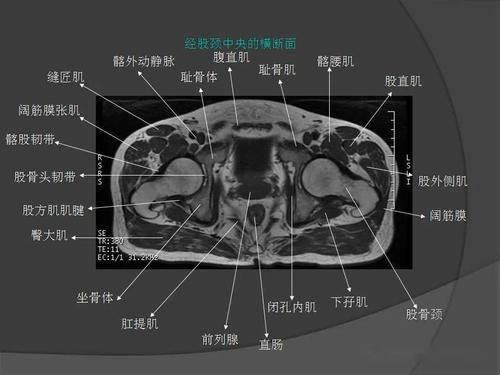 骨盆肌肉mri断层解剖