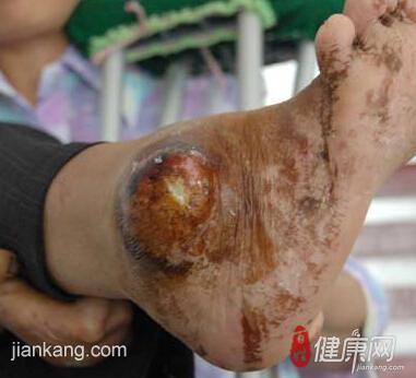 麻风病症状什么样