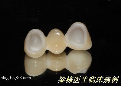 仿真修复系列之—固定桥二次修复(梁栋)