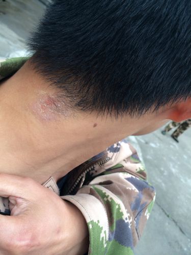 脖子后长一块癣,上一年夏天就长了,一直涂