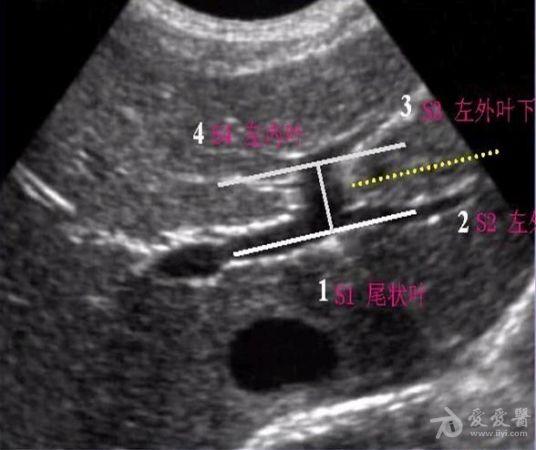肝脏的分叶分段(解剖 超声声像图)