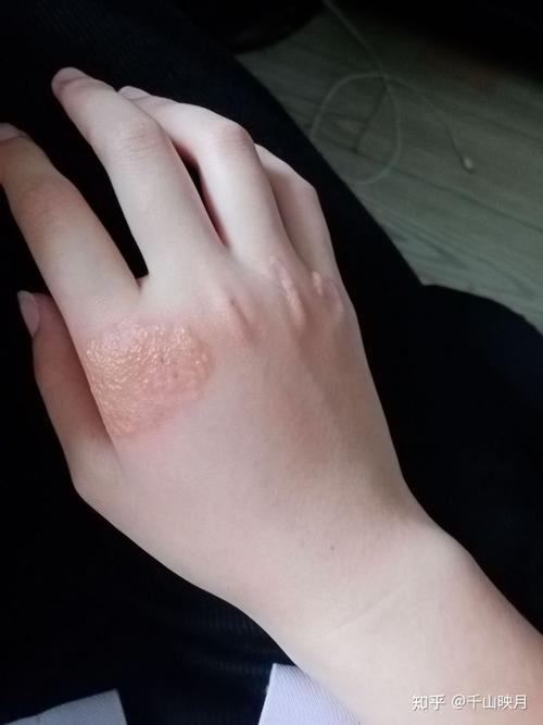 为什么有的人会对创可贴/胶布过敏?过敏原是什么?是过敏吗?