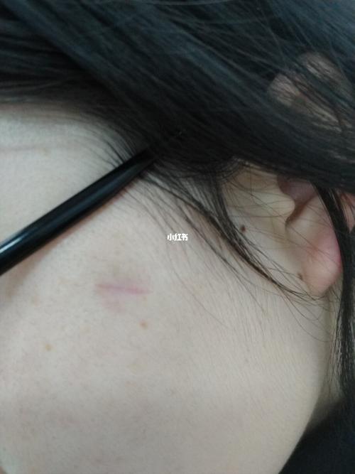 面部皮脂腺囊肿去疤恢复之路_去疤_疤痕_眼镜_药店_缝针去疤_美妆