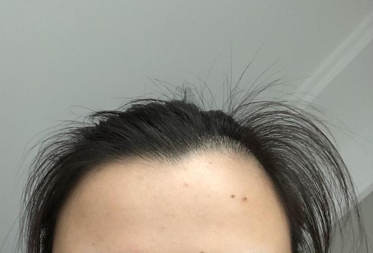 发际线长旋真是令人崩溃