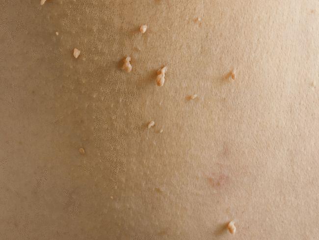 她皮肤上面出现的"小肉粒"就是感染了hpv病毒而引发的"疣体"的一种,名