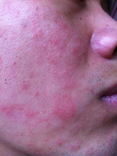 脸上起皮,皮下面就是红色斑点?也不痒痒,这是皮肤癣吗