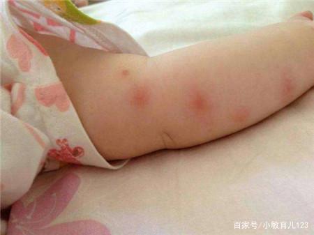 宝宝被蚊虫叮咬后,怎么快速消肿止痒?