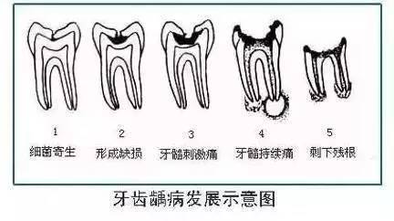 " 牙医却语重心长地说:"就目前医疗技术而言,做根管治疗后桩冠修复