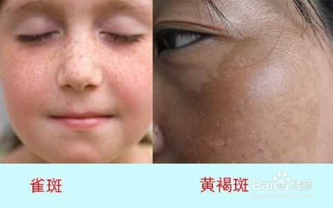 面部长斑最常见的,就是雀斑,与黄褐斑!